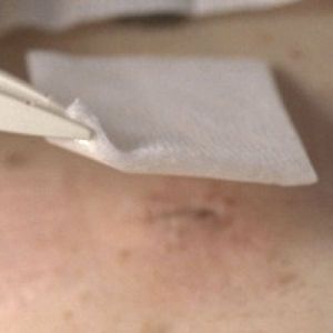 Melolin Steriles Absorbantes 10Cm*10Cm Compresse 10