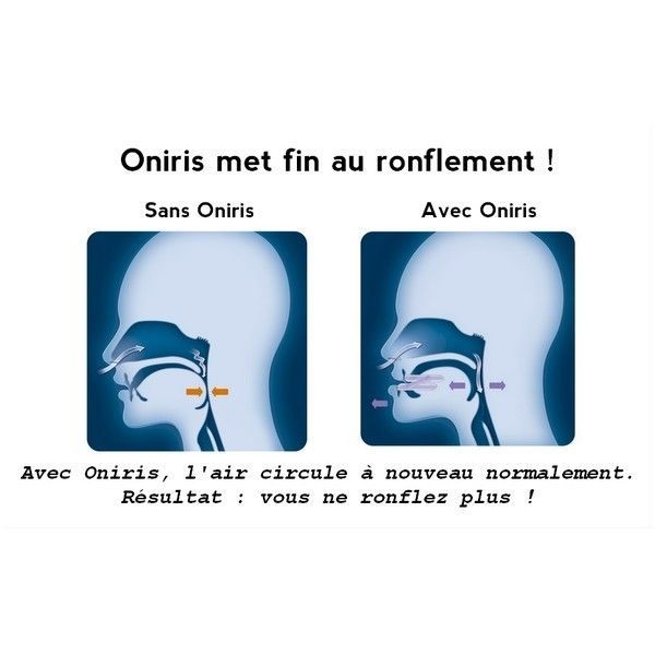 Oniris - Orthèse Anti Ronflement et Bruxisme